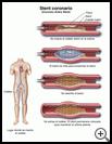 Thumbnail image of: Coronary Artery Stent: Illustration