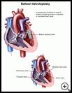 Thumbnail image of: Balloon Valvuloplasty: Illustration