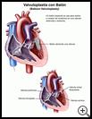 Thumbnail image of: Balloon Valvuloplasty: Illustration