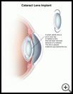 Thumbnail image of: Cataract Lens Implant: Illustration