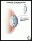 Thumbnail image of: Cataract Lens Implant: Illustration