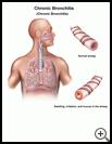 Thumbnail image of: Chronic Bronchitis: Illustration