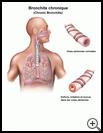 Thumbnail image of: Chronic Bronchitis: Illustration