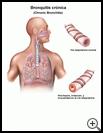 Thumbnail image of: Chronic Bronchitis: Illustration