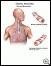 Thumbnail image of: Chronic Bronchitis: Illustration