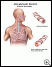 Thumbnail image of: Chronic Bronchitis: Illustration
