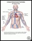 Thumbnail image of: Intravenous (IV) Central Lines: Illustration