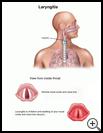 Thumbnail image of: Laryngitis: Illustration