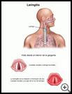 Thumbnail image of: Laryngitis: Illustration