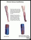 Thumbnail image of: Chronic Venous Insufficiency: Illustration