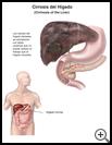 Thumbnail image of: Cirrhosis: Illustration