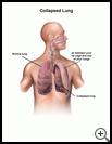 Thumbnail image of: Collapsed Lung: Illustration