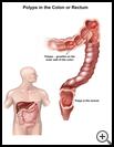 Thumbnail image of: Polyps in the Colon or Rectum: Illustration