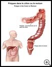 Thumbnail image of: Polyps in the Colon or Rectum: Illustration