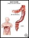 Thumbnail image of: Polyps in the Colon or Rectum: Illustration