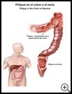 Thumbnail image of: Polyps in the Colon or Rectum: Illustration