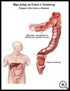 Thumbnail image of: Polyps in the Colon or Rectum: Illustration