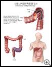 Thumbnail image of: Colonoscopy and Sigmoidoscopy: Illustration