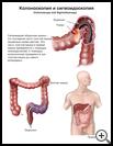 Thumbnail image of: Colonoscopy and Sigmoidoscopy: Illustration