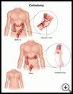 Thumbnail image of: Colostomy: Illustration