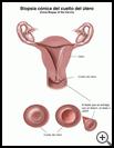 Thumbnail image of: Cone Biopsy of the Cervix: Illustration