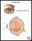 Thumbnail image of: Corneal Ulcer: Illustration