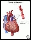 Thumbnail image of: Coronary Artery Spasm: Illustration