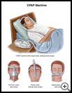 Thumbnail image of: CPAP Machine: Illustration