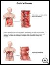 Thumbnail image of: Crohn's Disease: Illustration