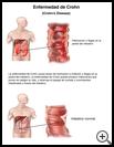 Thumbnail image of: Crohn's Disease: Illustration