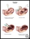Thumbnail image of: C-Section: Illustration