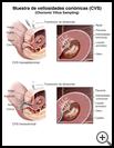 Thumbnail image of: Chorionic Villus Sampling (CVS): Illustration