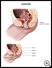 Thumbnail image of: Cystocele: Illustration