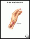 Thumbnail image of: De Quervain's Tenosynovitis: Illustration