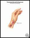 Thumbnail image of: De Quervain's Tenosynovitis: Illustration