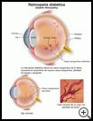 Thumbnail image of: Diabetic Retinopathy: Illustration