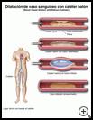 Thumbnail image of: Blood Vessel Dilation with Balloon Catheter: Illustration