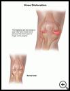 Thumbnail image of: Dislocated Knee: Illustration