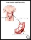 Thumbnail image of: Diverticulosis: Illustration