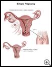 Thumbnail image of: Ectopic Pregnancy: Illustration