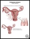 Thumbnail image of: Ectopic Pregnancy: Illustration