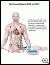 Thumbnail image of: Electrocardiogram (ECG or EKG): Illustration