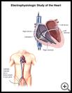 Thumbnail image of: Electrophysiologic Study of the Heart--Catheter Positions: Illustration
