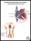 Thumbnail image of: Electrophysiologic Study of the Heart--Catheter Positions: Illustration