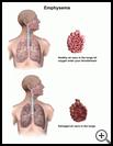Thumbnail image of: Emphysema: Illustration