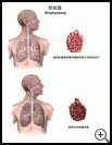 Thumbnail image of: Emphysema: Illustration