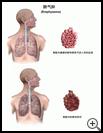 Thumbnail image of: Emphysema: Illustration