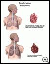 Thumbnail image of: Emphysema: Illustration