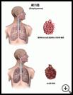 Thumbnail image of: Emphysema: Illustration
