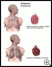 Thumbnail image of: Emphysema: Illustration